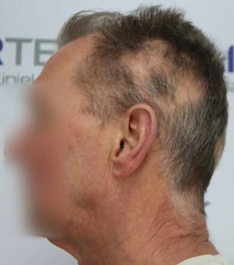 Voor-en-nafoto PRP-behandeling, links: kruin en slaap van een man, zijaanzicht, voor de eerste sessie, dunner wordend haar.