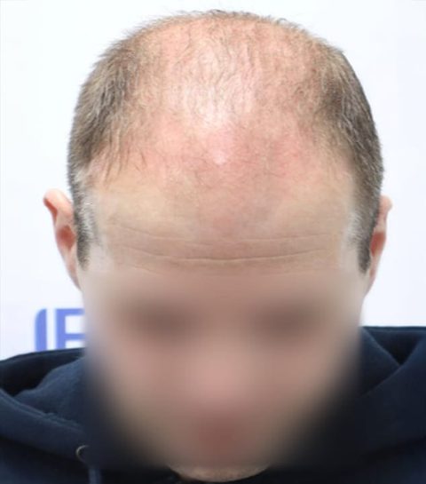 Voor-en-nafoto PRP-behandeling, links: kruin van een man, bovenaanzicht, voor de eerste sessie, de hoofdhuid schemert door.