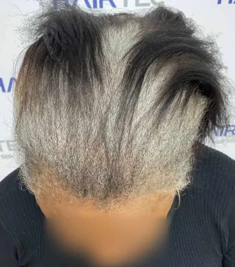 Voor-en-nafoto PRP-behandeling, rechts: hetzelfde bovenaanzicht twaalf maanden na de start van de kuur, duidelijk meer haardichtheid.