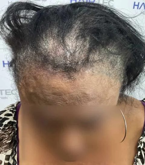 Voor-en-nafoto PRP-behandeling, links: bovenaanzicht van een vrouw met donker haar en diffuse haaruitval, voor de eerste sessie.