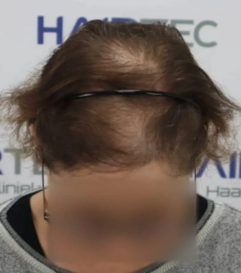 Voor-en-nafoto PRP-behandeling, links: scheiding van een vrouw, vooraanzicht, voor de eerste sessie, bredere scheiding met zichtbare hoofdhuid.
