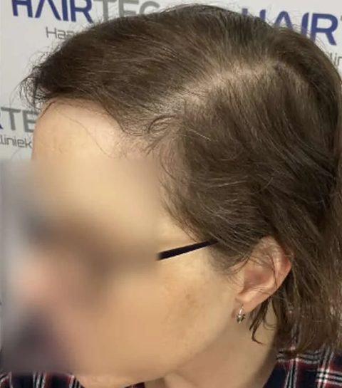 Voor-en-nafoto PRP-behandeling, rechts: dezelfde zijscheiding twaalf maanden na de start van de kuur, de hoofdhuid is bedekt.
