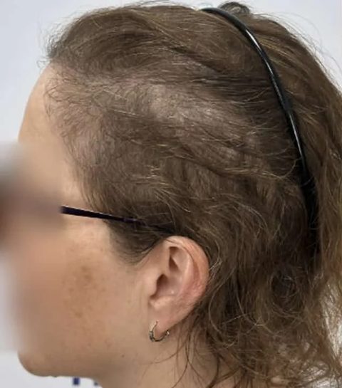 Voor-en-nafoto PRP-behandeling, links: zijscheiding van een vrouw voor de eerste sessie, de hoofdhuid is zichtbaar.