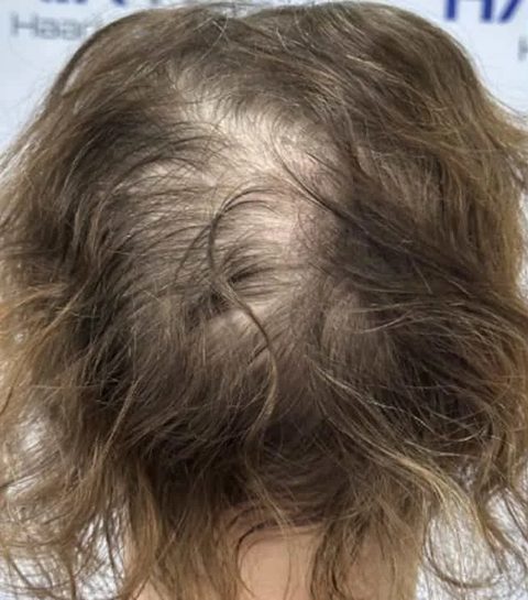 Voor-en-nafoto PRP-behandeling, links: bovenaanzicht van een vrouw met krullend haar voor de eerste sessie, dunner wordend haar op de kruin.