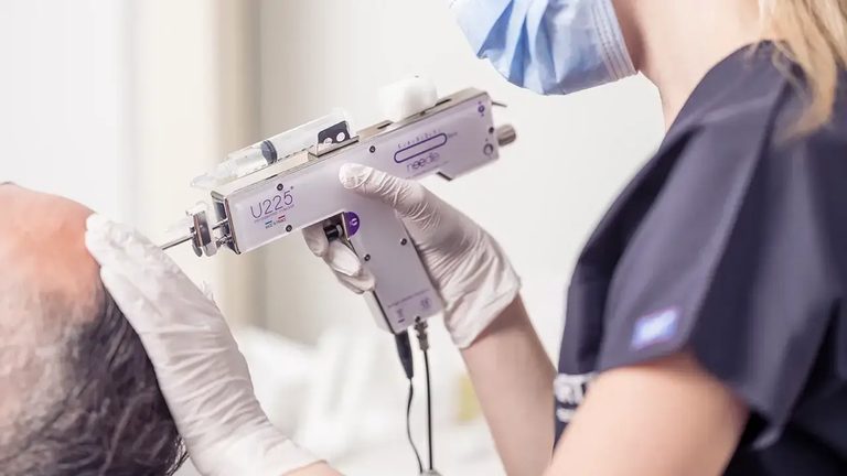 Haarspecialist van Hairtec in de kliniek in Delft brengt het plasma met de meso-injector in de hoofdhuid van een patiënt