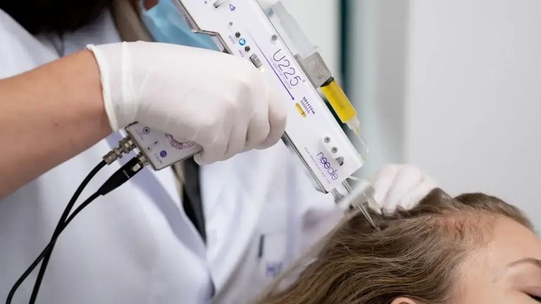 PRP-behandeling bij Hairtec: de meso-injector verdeelt het plasma over de hoofdhuid van een patiënte