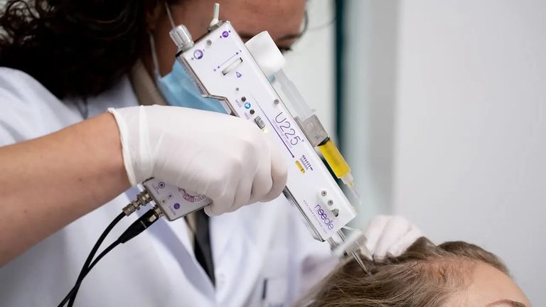 Haarspecialist van Hairtec brengt plasma met de meso-injector in de hoofdhuid van een patiënte
