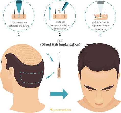 DHI Vs FUE: Welke Haartransplantatie Methode Is Beter?