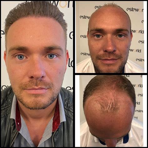 Ervaringen Van Mensen Met Haartransplantatie