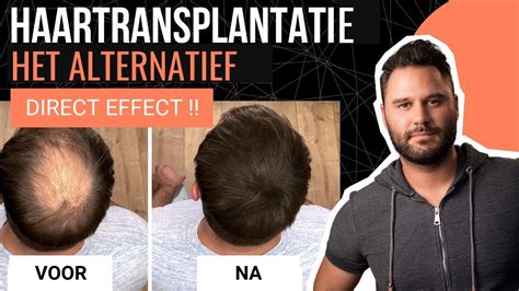 Haartransplantatie Kosten: Bespreek Dit Met Je Arts