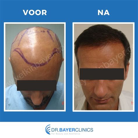 Haartransplantatie Voor En Na: Fotogalerij En Inspiratie