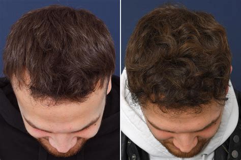 Haartransplantatie Voor Leeftijdsgerelateerd Haarverlies