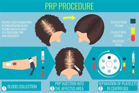 PRP Therapie Voor Haarherstel: Wat Je Moet Weten