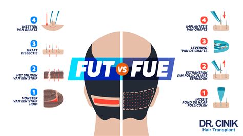 Vergelijking Tussen FUE En FUT Haartransplantatie