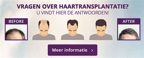 Haartransplantatie Behandeling: De Meest Voorkomende Mythen