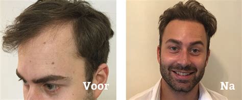 Haartransplantatie Behandeling: Hoe Te Herstellen Als Een Pro