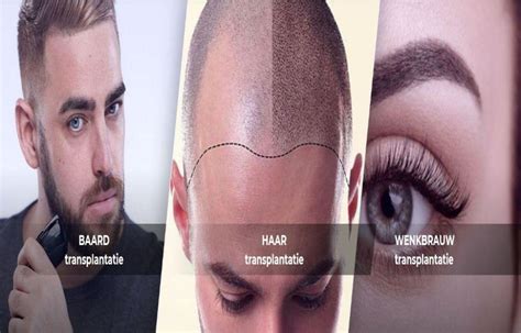 Haartransplantatie In Nederland: Trends En Ontwikkelingen