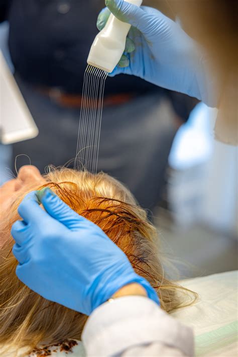 Haartransplantatie: Een Oplossing Voor Dunner Wordend Haar