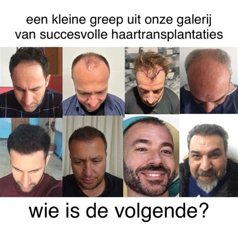 Haartransplantatie In De Media: Succesverhalen