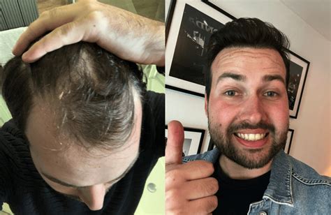 De Impact Van Lifestyle Op Haartransplantatie Resultaten