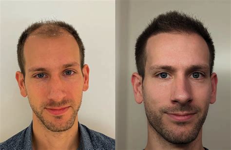Ervaringen Van Klanten: Haartransplantatie Resultaten