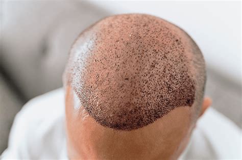 Haartransplantatie En COVID-19: Wat Wil Je Weten?