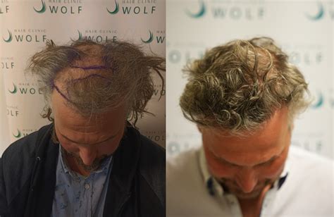 Haartransplantatie Voor Senioren: Veiligheid En Effectiviteit