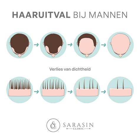 Haaruitval Bij Jonge Mannen: Wat Te Doen?