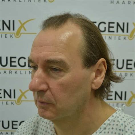 Kies De Juiste Haartransplantatie Methode Voor Jou