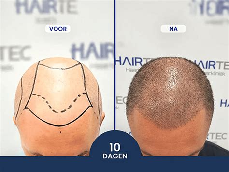 Regelmatig Haarverzorging Na Een Haartransplantatie