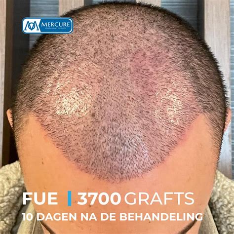 Saffier FUE Haartransplantatie: Wat Zet Het Apart?